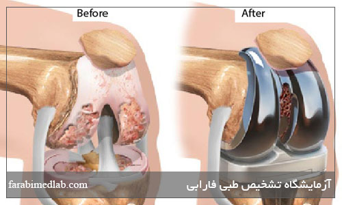 جراحی زانو