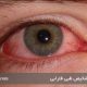 علائم سرطان چشم