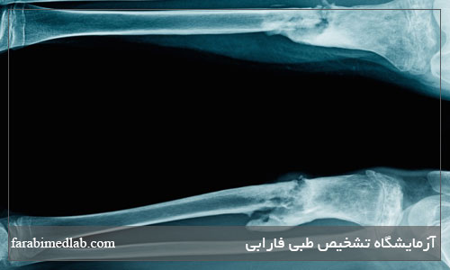علائم عفونت استخوان