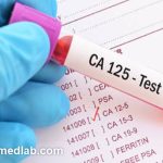 انجام آزمایش CA125 در آزمایشگاه فارابی
