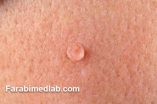 چه زمانی باید آزمایش HPV انجام داد؟