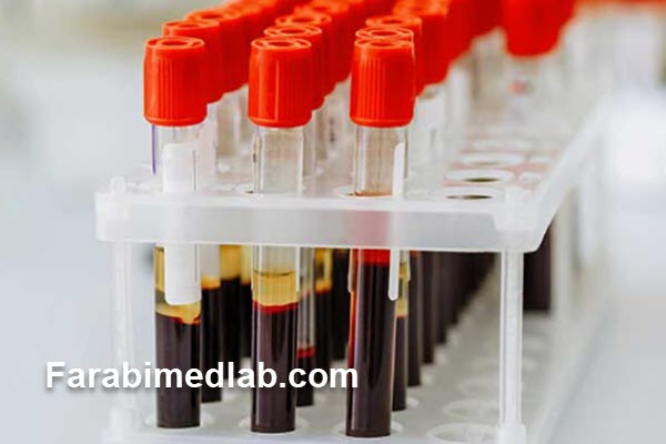 آزمایش-CRP-و-ESR-چه-تفاوتی-دارند؟ آزمایش CRP و ESR چه تفاوتی دارند؟
